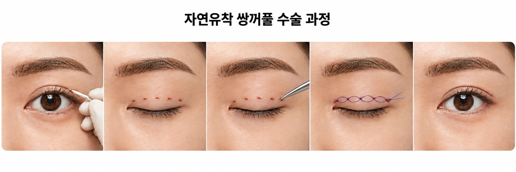 눈성형 설명 이미지