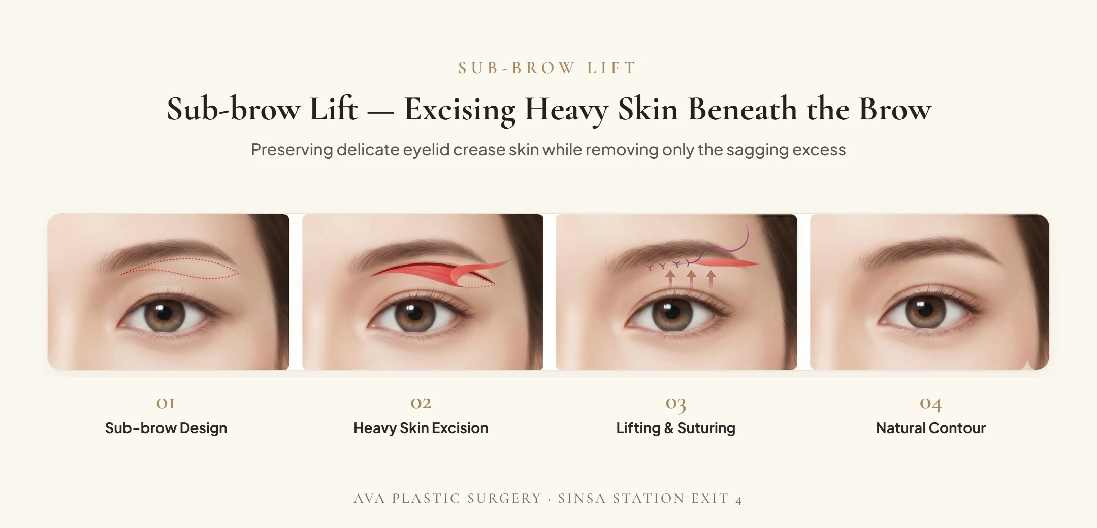 Sub-brow Lift 4-step surgical diagram: excising heavy skin beneath the brow