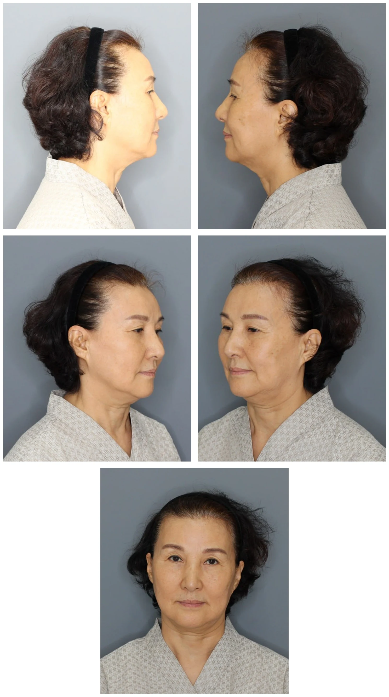 Before surgery — 5-angle clinical evaluation of Dr. Kim's mother