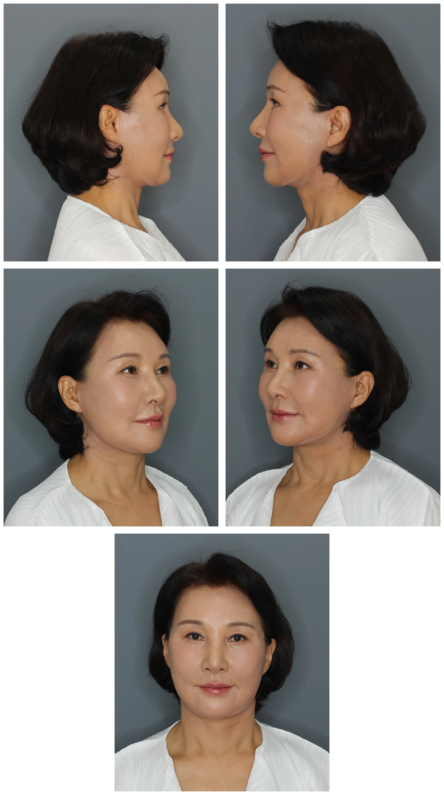 Why I Performed a Deep-Plane Facelift & Eyelid Surgery on My Own Mother — 2-Month Recovery Log