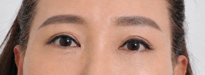 Eye surgery after