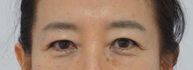 Eye surgery before