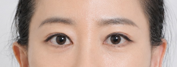 Eye surgery after