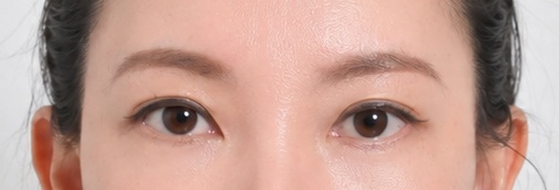 Eye surgery after